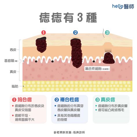 痣長毛代表什麼|痣形成的原因？痣長毛、痣變多變大是痣病變？5招判。